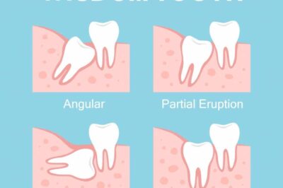 How to Tell If Your Wisdom Teeth Are Coming In
