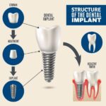 Dental Implant Post