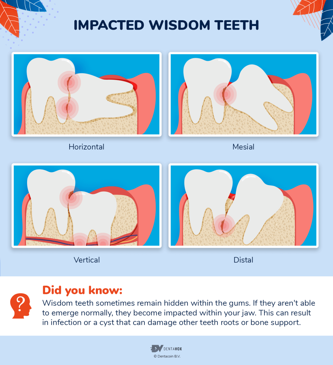 Signs And Symptoms Of Wisdom Teeth Coming In