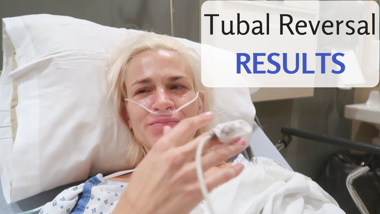 Fertility After Tubal Reversal